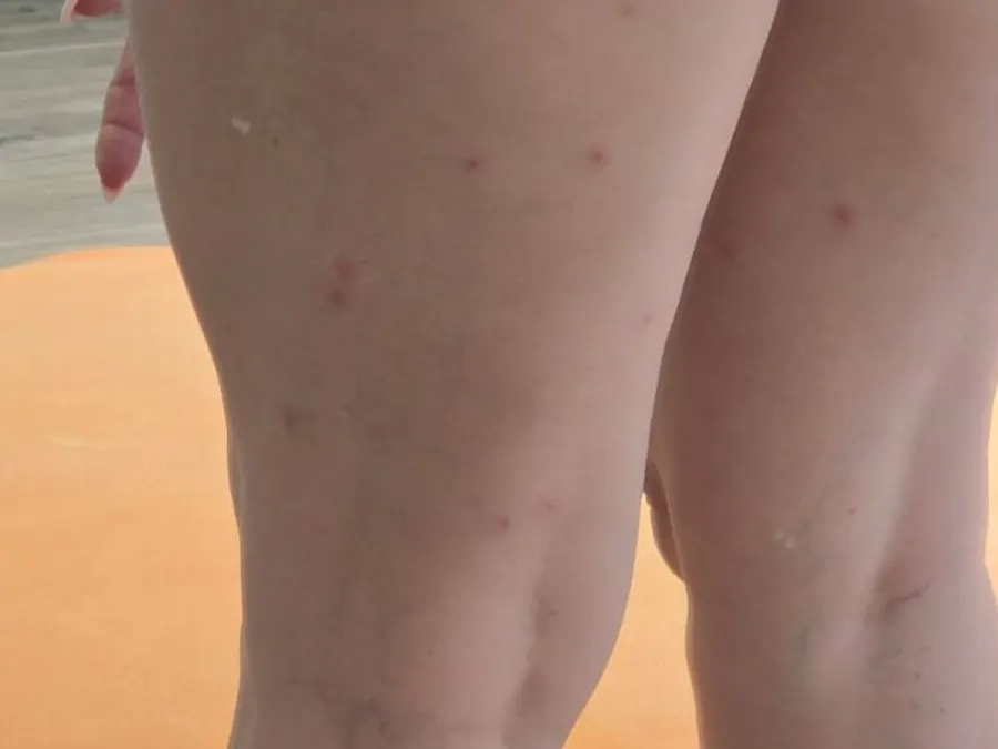 Uštipnutia od ploštíc na nohách